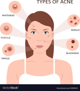 types-of-acne-woman-with-pimples-vector-14585045